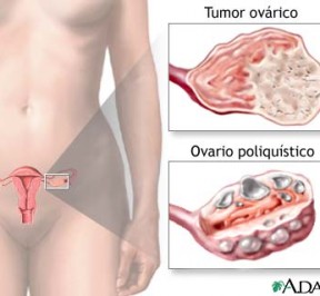 ovario-poliquistico