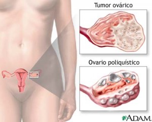 ovario-poliquistico